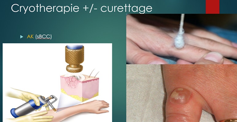 Dermatologie cryotherapie